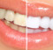 Why You Should Make Your Teeth Whiter Using Home Remedies?