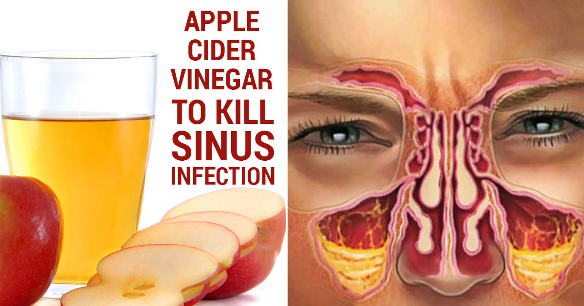 Will A Sinus Infection Go Away On Its Own