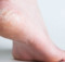 Yes, Dry, Cracked and Itchy Feet Could be treated on a Natural Way