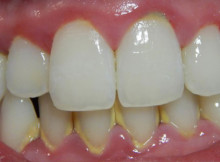 12 Home Remedies to Cure Silent Killer on a Natural Ways, We are talking About Gum Disease