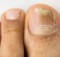 How to Deal With Toenail Fungus?