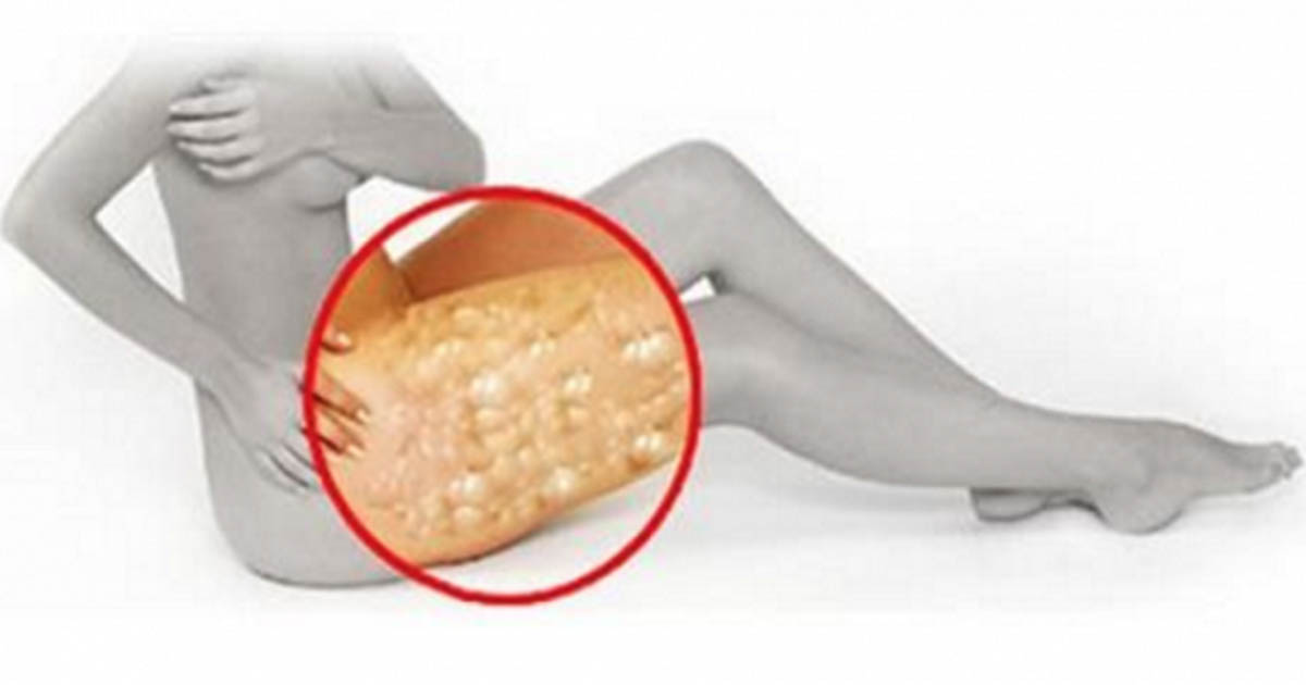magnesiumöl cellulite