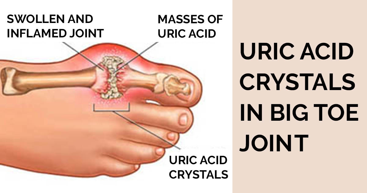 How to Control Uric Acid Levels Healthy Natural Solution