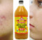 Put Apple Cider Vinegar on Your Face and See What Happens To Toxins, Eczema, and Age Spots