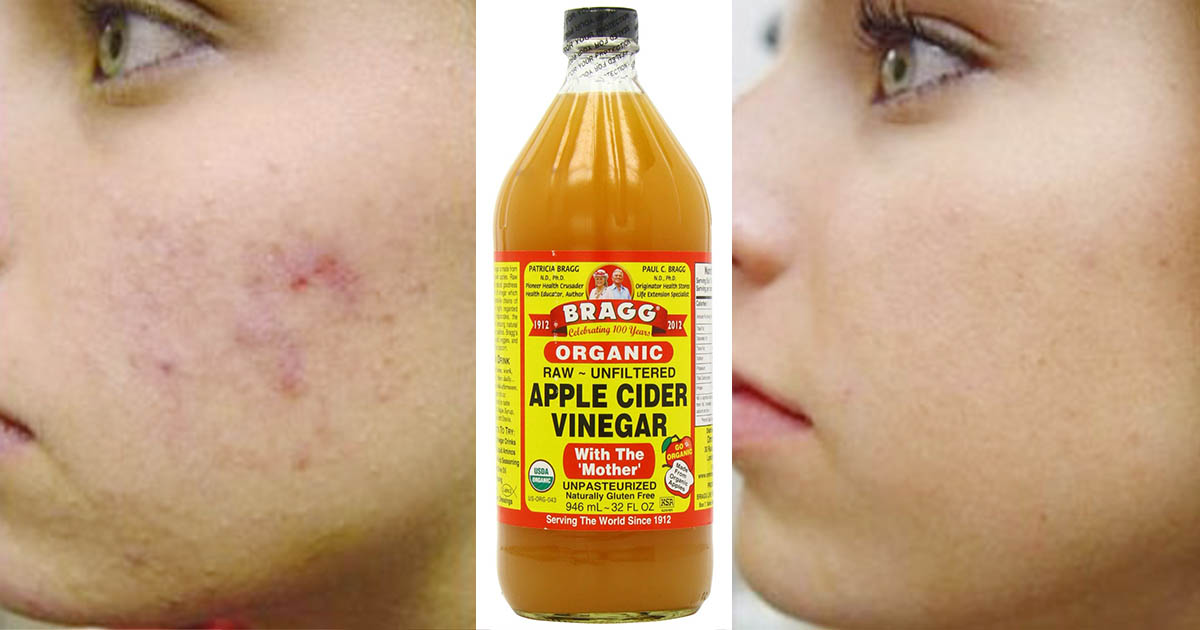 Put Apple Cider Vinegar on Your Face and See What Happens To Toxins, Eczema, and Age Spots