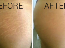 Remove Those Ugly Stretch Marks With This Amazing Carrot Paste