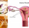 The combination of the two ingredients that can help you SAY GOODBYE to cysts and fibroids!