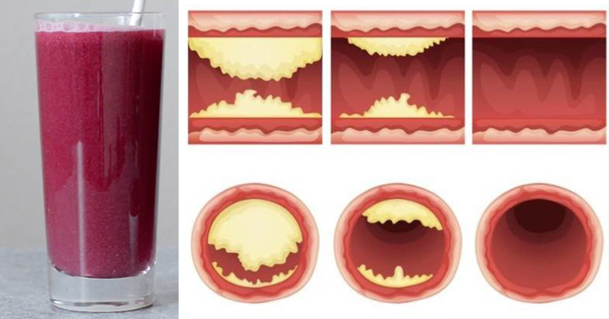 This Juice Unclogs Arteries & Protects Against Heart Disease! Healthy