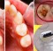 4 Basic Steps That Will Easily Remove Your Cavities!