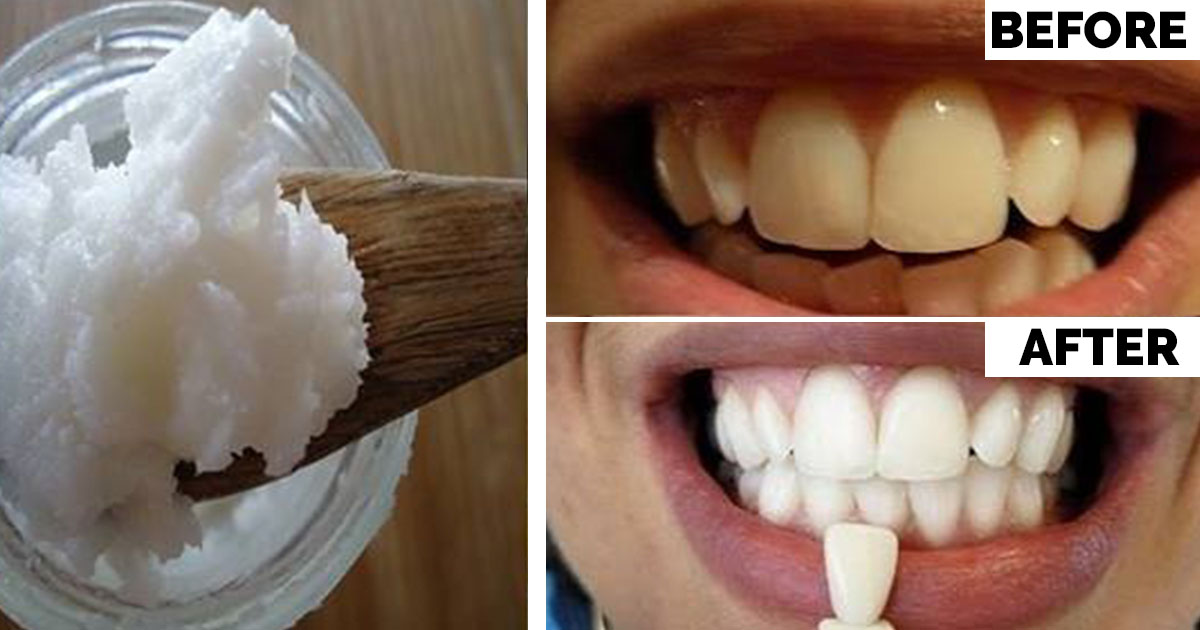 Gargle With One Simple Ingredient and See What Happens To Your Teeth