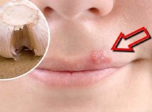 Get Rid Of Herpes Using a Simple Trick