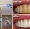 How To Get Rid Of Plaque and Whiten Your Teeth Without Expensive Treatments