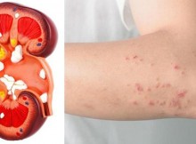 If Your Kidney Is in Danger, the Body Will Give You These 8 Signs!