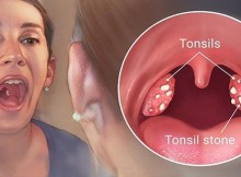 4 Effective Ways to Remove Tonsil Stones without Surgery