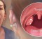 4 Effective Ways to Remove Tonsil Stones without Surgery