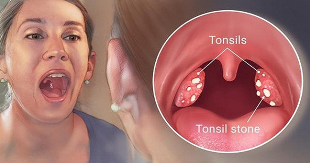 4 Effective Ways to Remove Tonsil Stones without Surgery Healthy