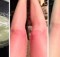 Cool Your Burn With This Homemade Sunburn Relief!