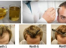 Do You Want To Regain Your Hair Discover This Unique Method to Regenerate Hair!