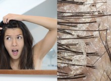 Easy Home Remedies to Get Rid of Dandruff