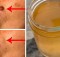 Remove Age Spots, Moles, Warts and Pimples in A Completely Natural Way