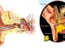 Causes for Ear Wax Buildup and How to Remove It At Home