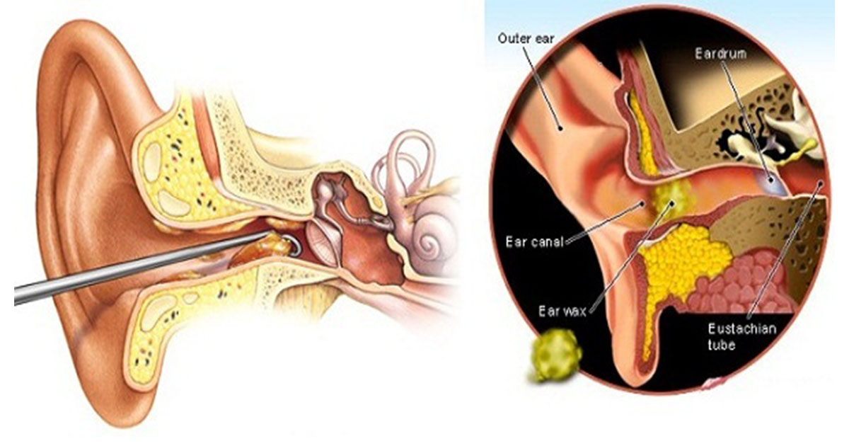 Natural Ear Drops To Remove Wax Natural Ear Drops To Remove Wax