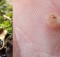 How to Use Essential Oil for Treating Warts Naturally